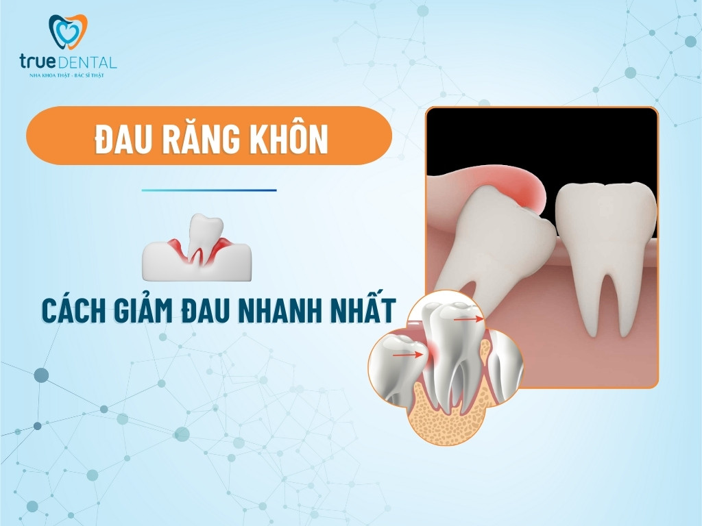 Đau răng khôn - Cách giảm đau nhanh nhất tại nhà đơn giản 6 dau rang khon 1