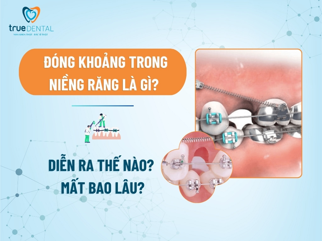 ĐÓNG KHOẢNG TRONG NIỀNG RĂNG LÀ GÌ? DIỄN RA THẾ NÀO? MẤT BAO LÂU?