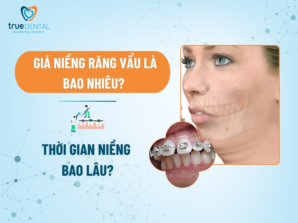 GIÁ NIỀNG RĂNG VẨU LÀ BAO NHIÊU? THỜI GIAN NIỀNG BAO LÂU?