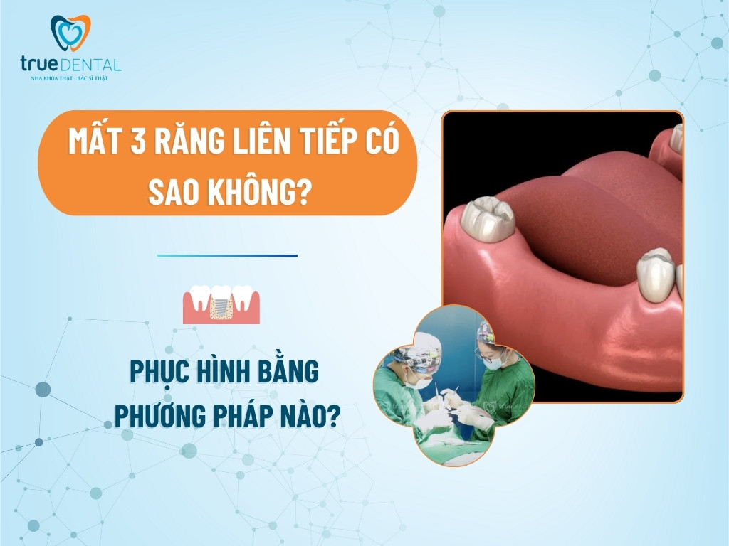 MẤT 3 RĂNG LIÊN TIẾP CÓ SAO KHÔNG? PHỤC HÌNH BẰNG PHƯƠNG PHÁP NÀO?