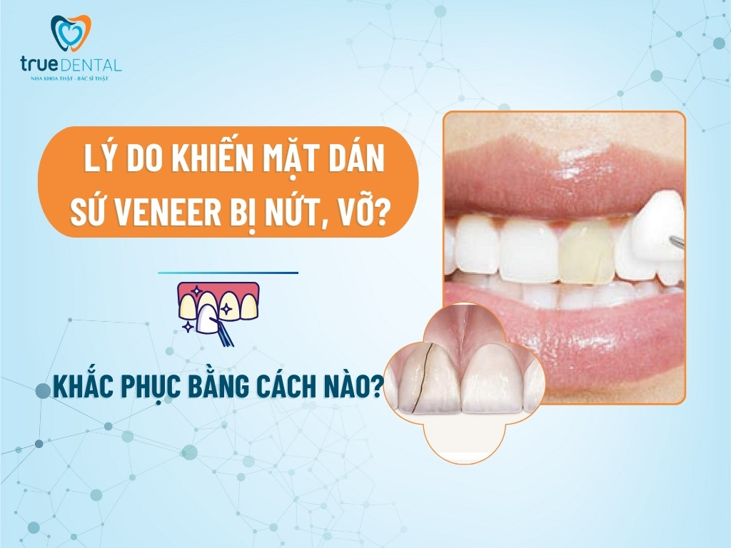 LÝ DO KHIẾN MẶT DÁN SỨ VENEER BỊ NỨT, VỠ? KHẮC PHỤC BẰNG CÁCH NÀO?