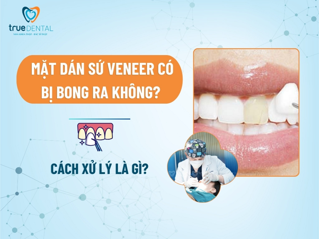 MẶT DÁN SỨ VENEER CÓ BỊ BONG RA KHÔNG? CÁCH XỬ LÝ LÀ GÌ?