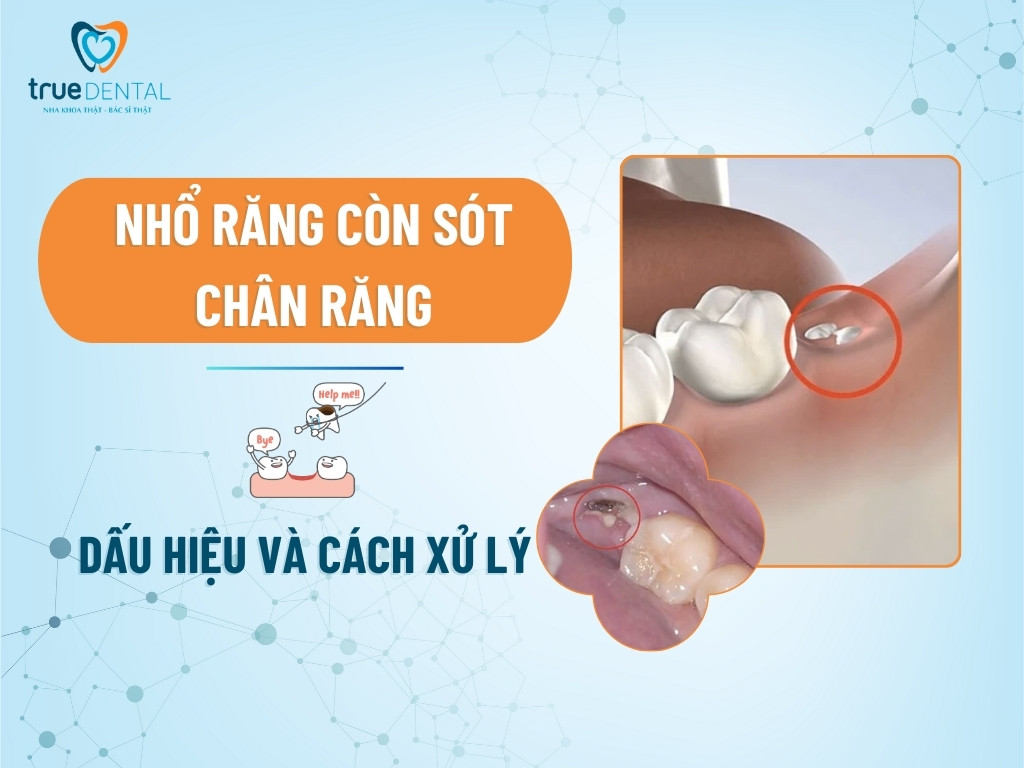 NHỔ RĂNG CÒN SÓT CHÂN RĂNG: DẤU HIỆU VÀ CÁCH XỬ LÝ