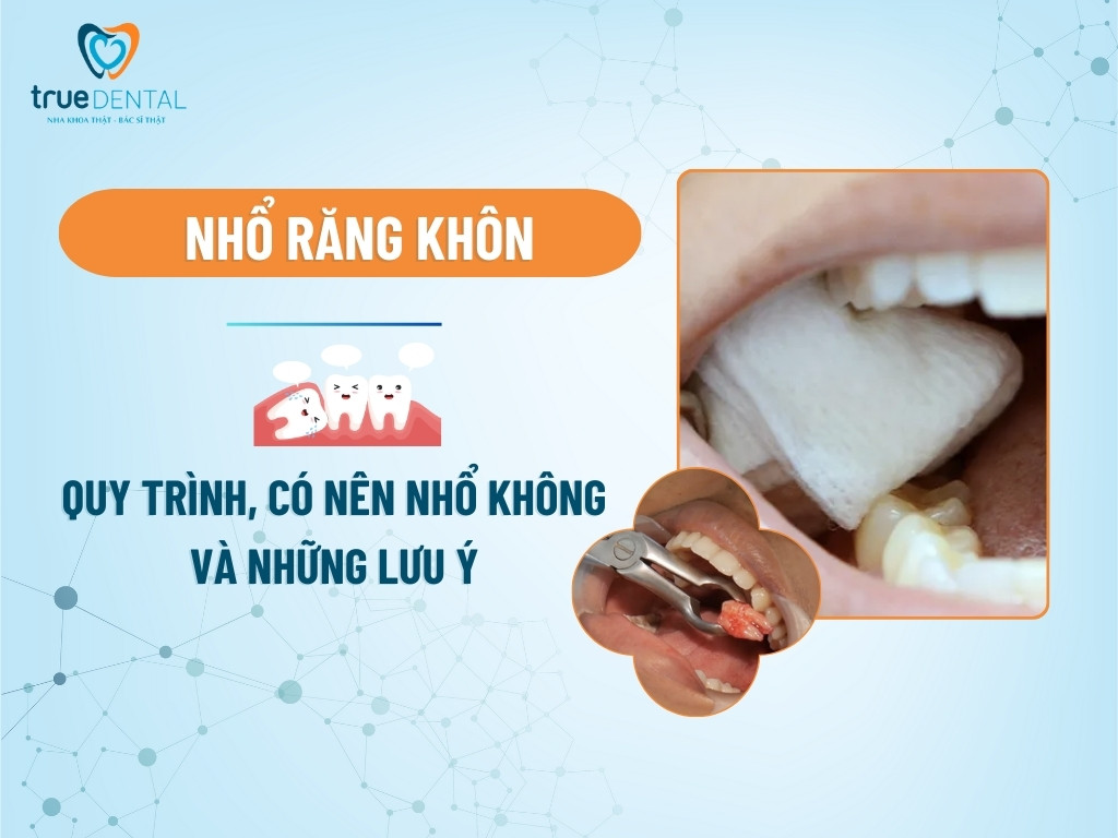 Nhổ răng khôn: Quy trình, có nên nhổ không và những lưu ý