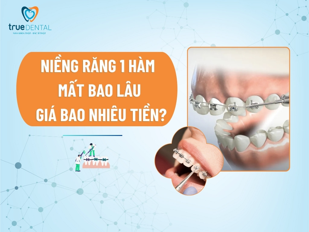 Niềng răng 1 hàm mất bao lâu, giá bao nhiêu tiền?