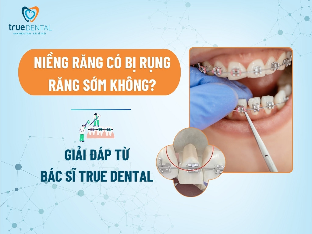 Niềng răng có bị rụng răng sớm không? 2 NIỀNG RĂNG CÓ BỊ RỤNG RĂNG SỚM KHÔNG? GIẢI ĐÁP TỪ BÁC SĨ TRUE DENTAL