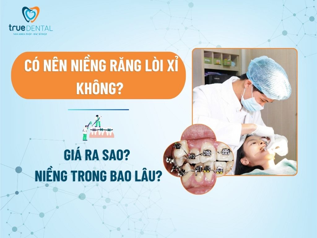 CÓ NÊN NIỀNG RĂNG LÒI XỈ KHÔNG? GIÁ RA SAO? NIỀNG TRONG BAO LÂU?