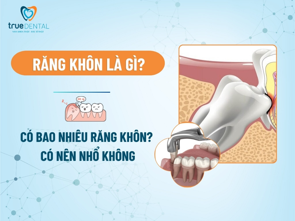 Răng khôn là gì? Có bao nhiêu răng khôn? Có nên nhổ không