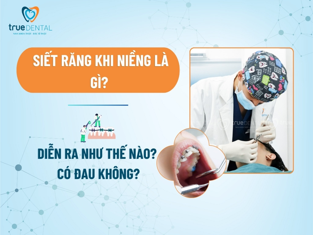 SIẾT RĂNG KHI NIỀNG LÀ GÌ? DIỄN RA NHƯ THẾ NÀO? CÓ ĐAU KHÔNG?