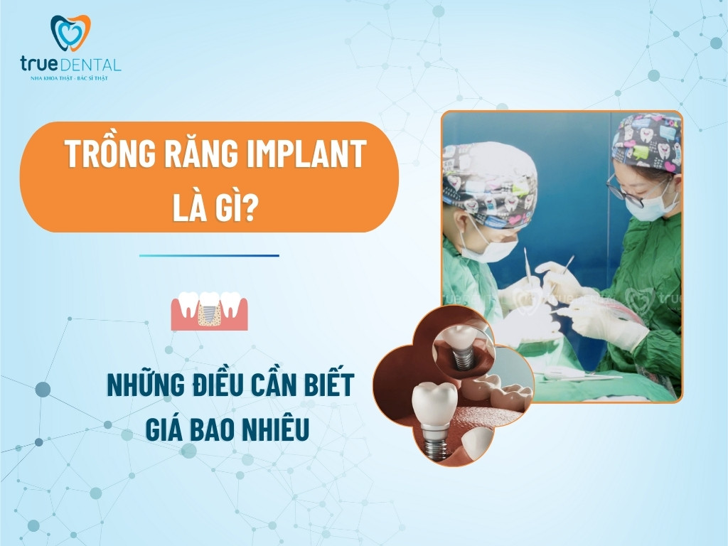 Trồng răng Implant là gì? Những điều cần biết, giá bao nhiêu