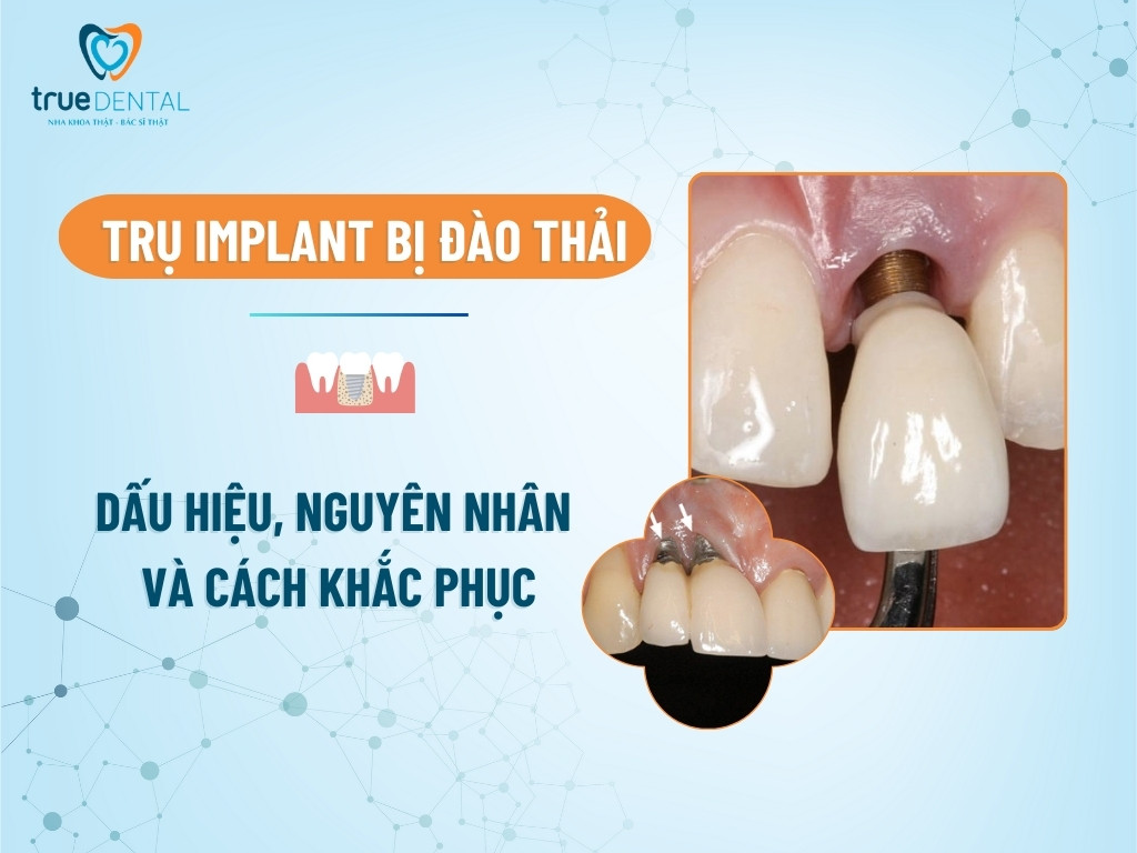 TRỤ IMPLANT BỊ ĐÀO THẢI: DẤU HIỆU, NGUYÊN NHÂN VÀ CÁCH KHẮC PHỤC