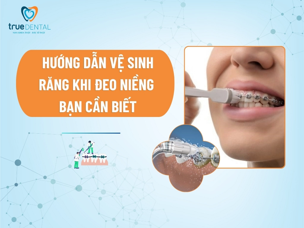 HƯỚNG DẪN VỆ SINH RĂNG KHI ĐEO NIỀNG BẠN CẦN BIẾT