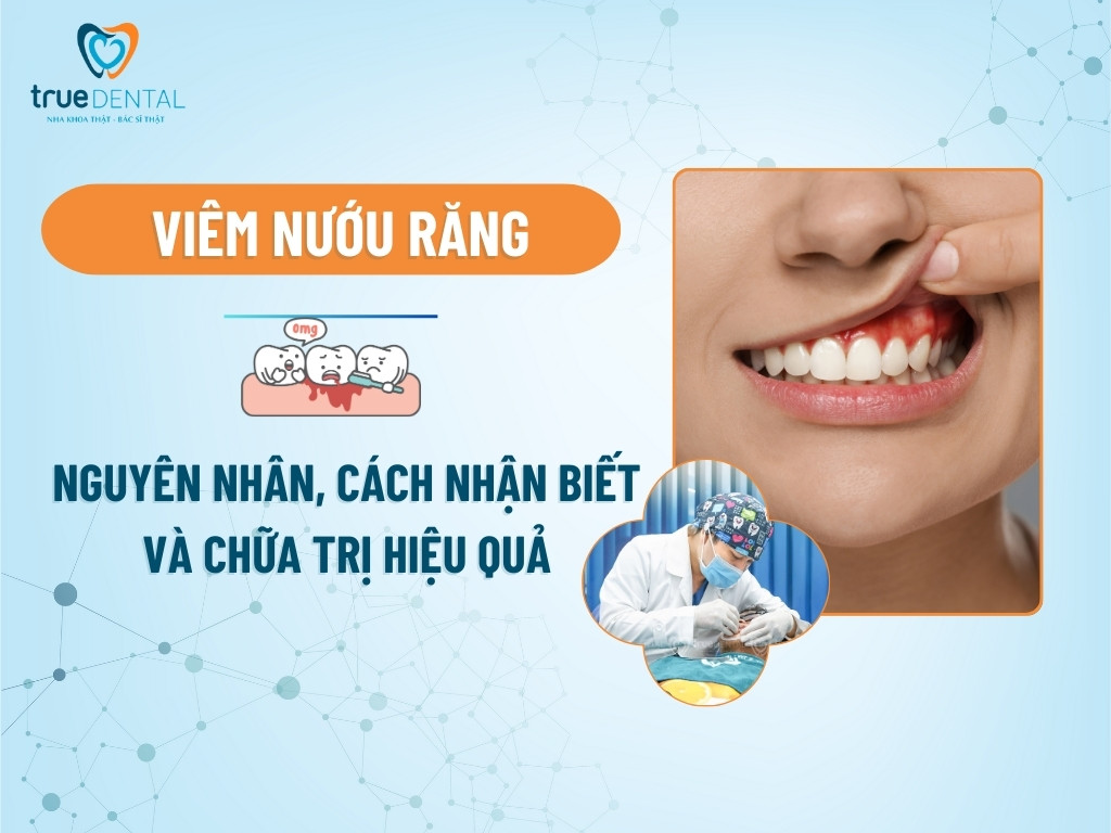 VIÊM NƯỚU RĂNG: NGUYÊN NHÂN, CÁCH NHẬN BIẾT VÀ CHỮA TRỊ HIỆU QUẢ