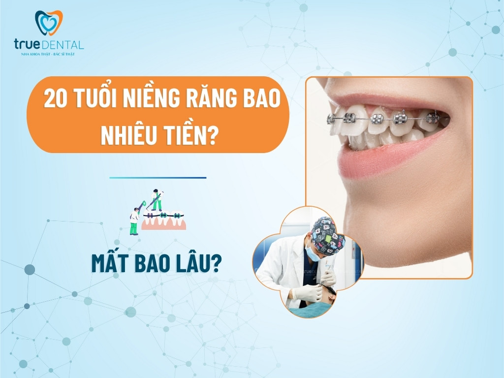 20 tuổi niềng răng bao nhiêu tiền? Mất bao lâu?
