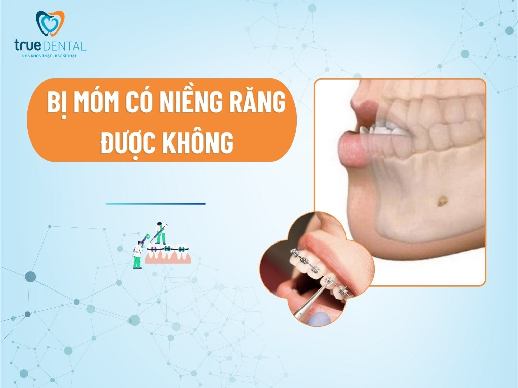 bị móm có niềng răng được không
