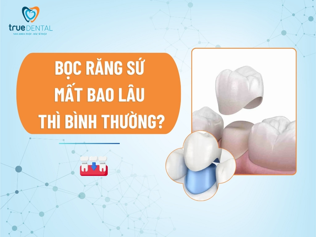 Bọc răng sứ mất bao lâu thì bình thường?