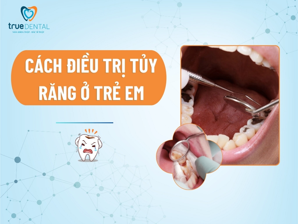 cách điều trị viêm tủy răng ở trẻ em
