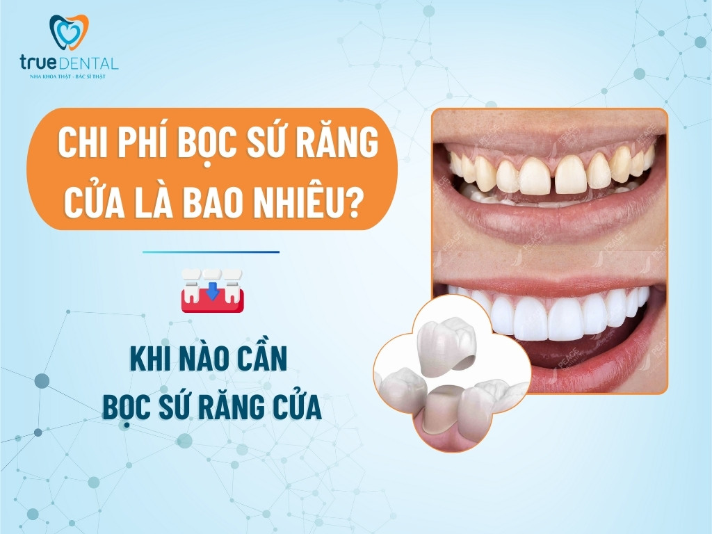Chi phí bọc sứ răng cửa là bao nhiêu? Khi nào cần bọc sứ răng cửa