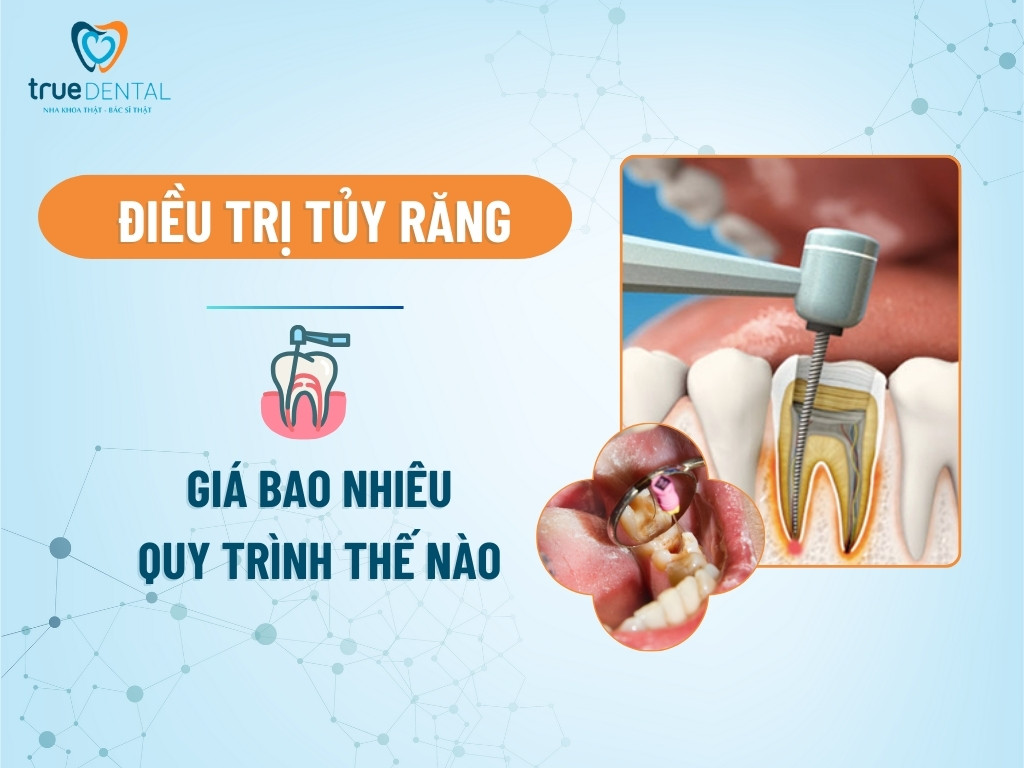 Điều trị tủy răng: Giá bao nhiêu, quy trình thế nào