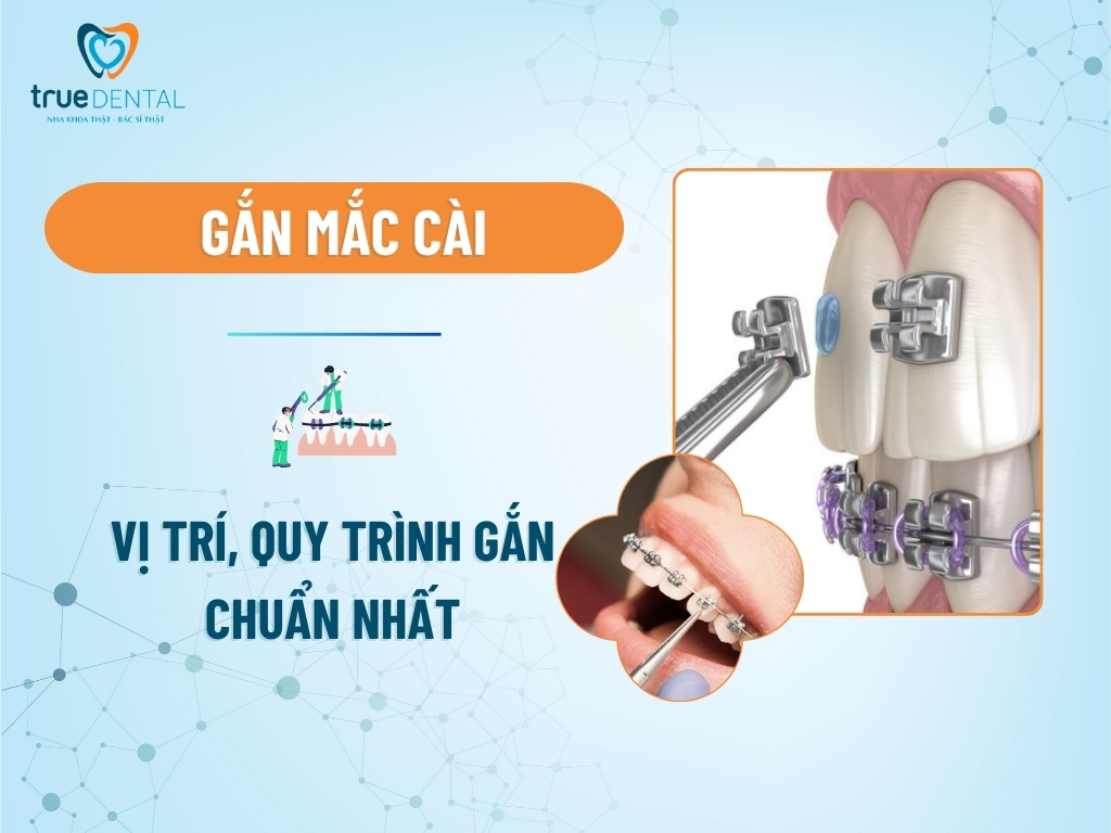 Gắn mắc cài: Vị trí, quy trình gắn chuẩn nhất