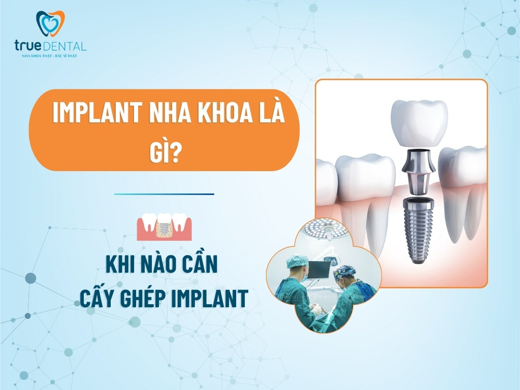 Implant nha khoa là gì? khi nào cần cấy ghép implant