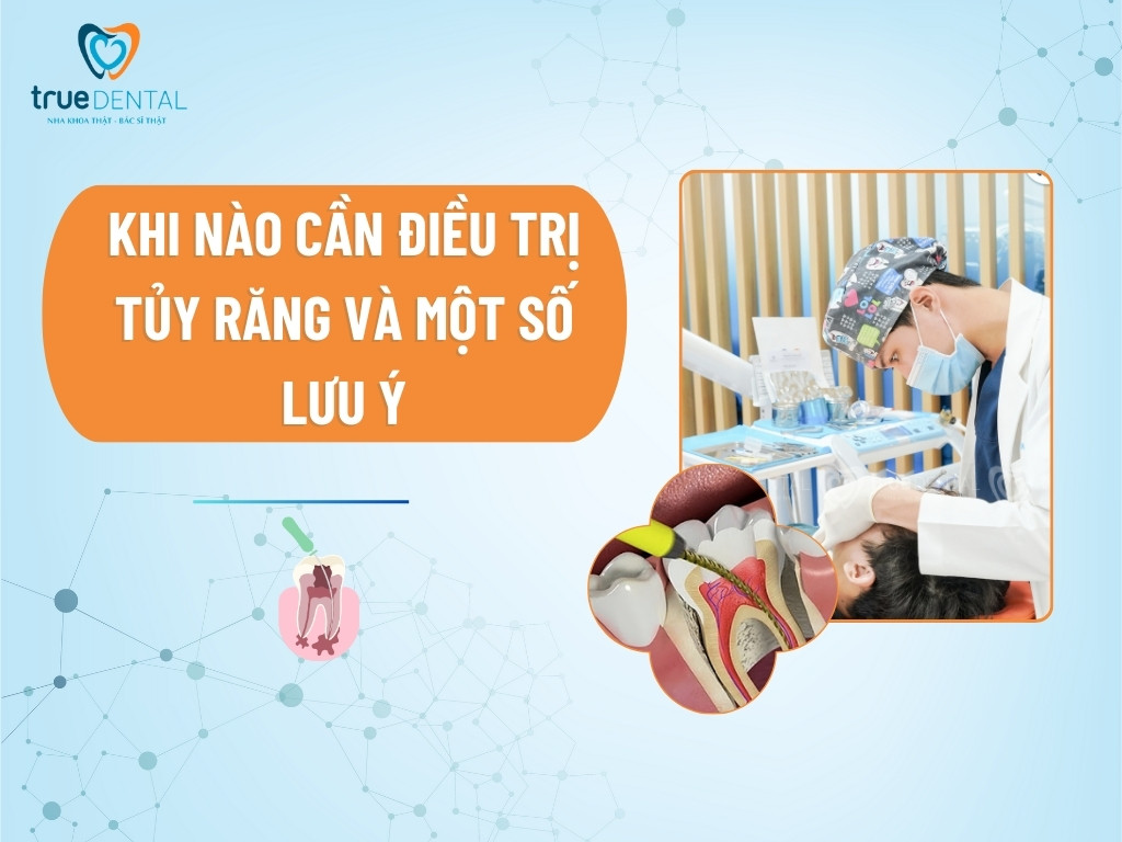 Khi nào cần điều trị tủy răng và một số lưu ý
