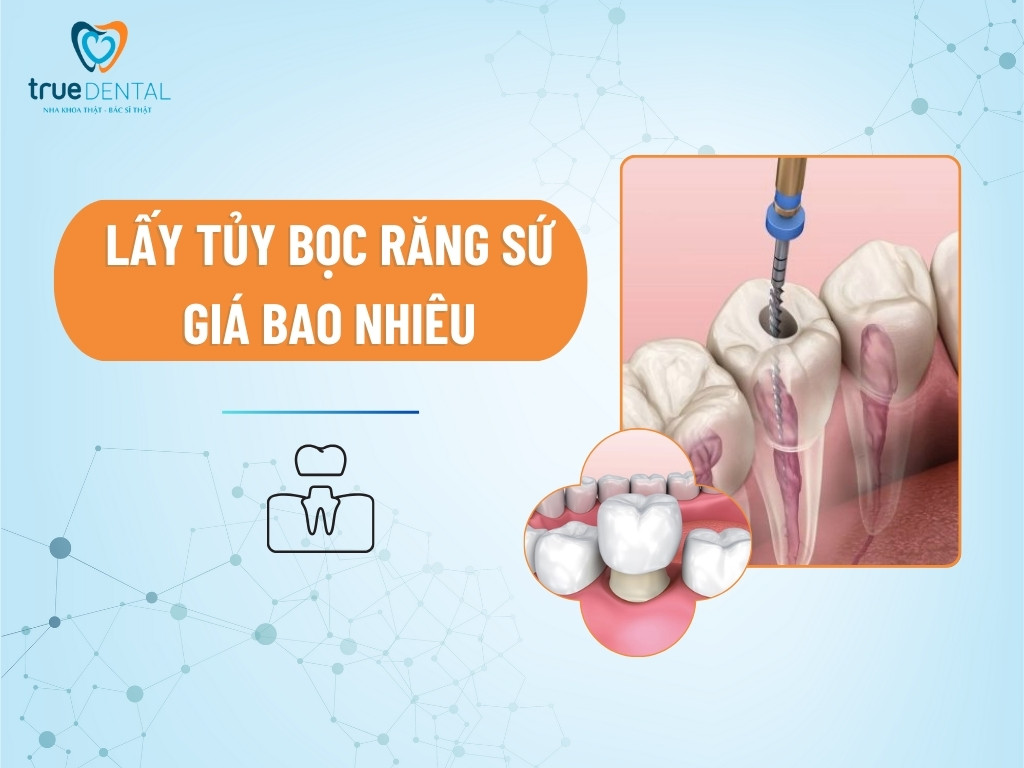 Lấy tủy bọc răng sứ giá bao nhiêu? Chi phí mới nhất 2025 1 Lấy tủy bọc răng sứ giá bao nhiêu