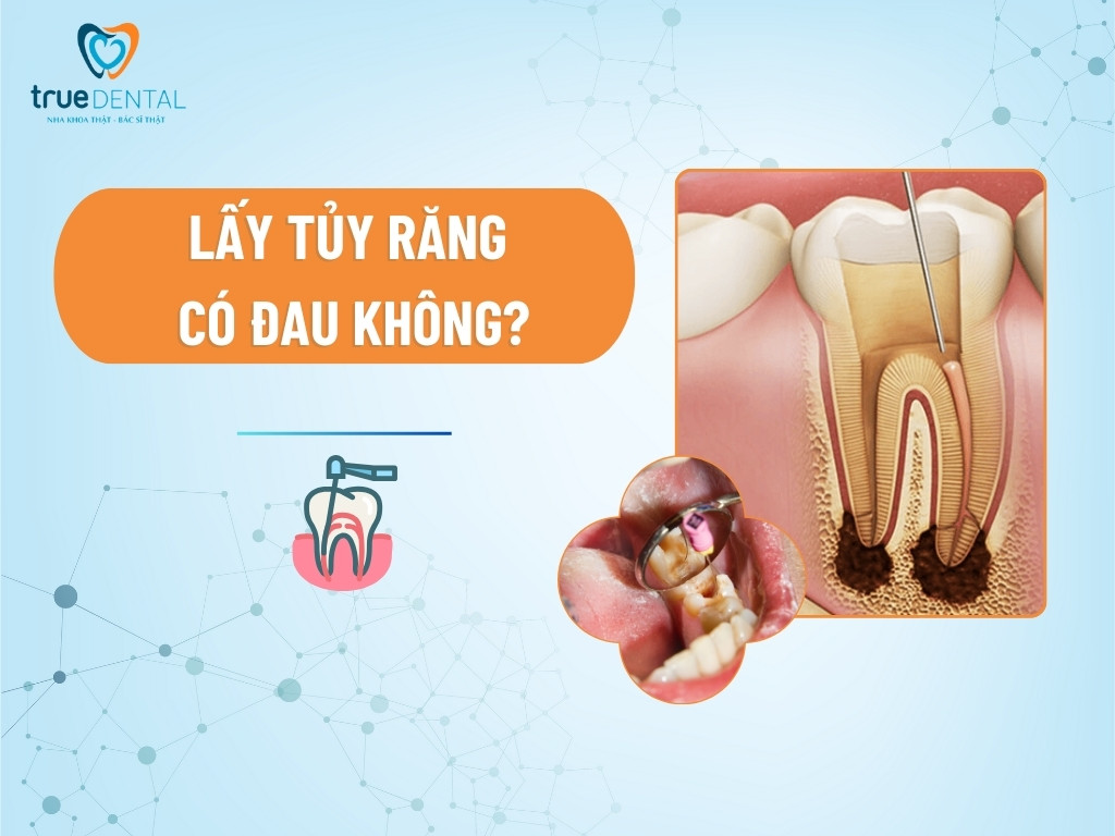 Lấy tủy răng có đau không? Lưu ý và quy trình lấy tủy răng 7 Lấy tủy răng có đau không?