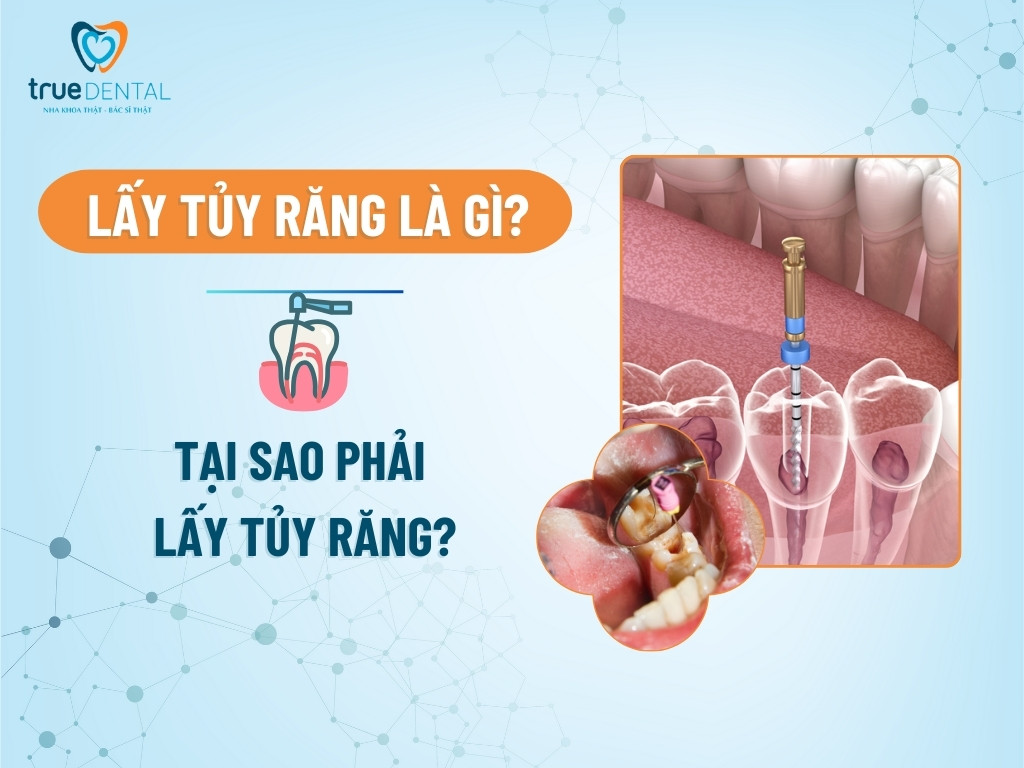 Lấy tủy răng là gì? Tại sao phải lấy tủy răng?