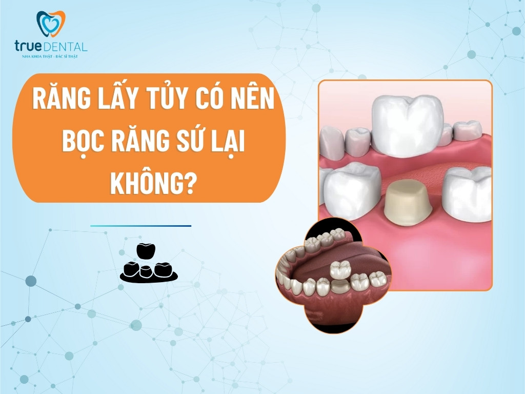 Răng lấy tủy có nên bọc răng sứ lại không?