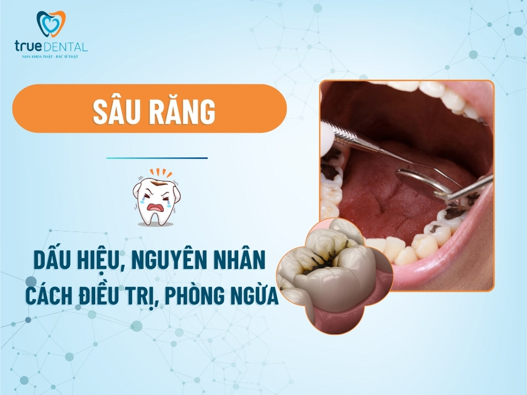 Sâu răng: Dấu hiệu, nguyên nhân, cách điều trị và phòng ngừa 4 Sâu răng: Dấu hiệu, nguyên nhân, cách điều trị và phòng ngừa