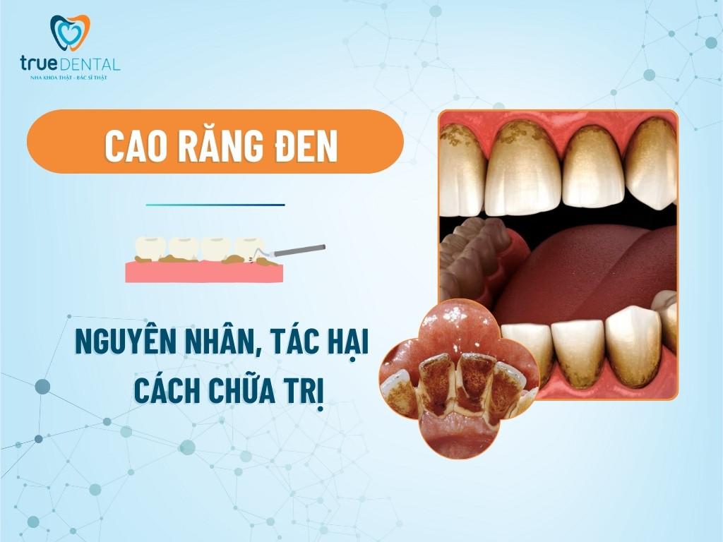 Cao răng đen: Nguyên nhân, tác hại và cách chữa trị