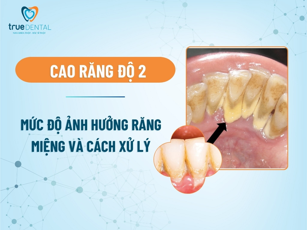 Cao răng độ 2: Mức độ ảnh hưởng răng miệng và cách xử lý