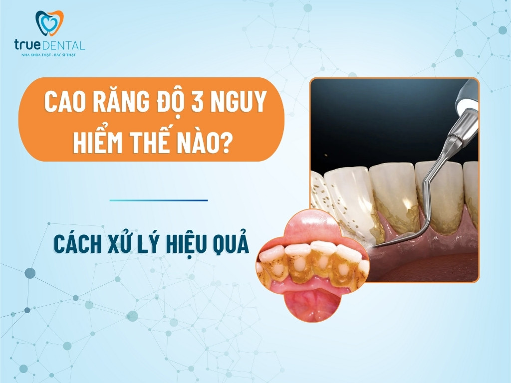 Cao răng độ 3 nguy hiểm thế nào? Cách xử lý hiệu quả