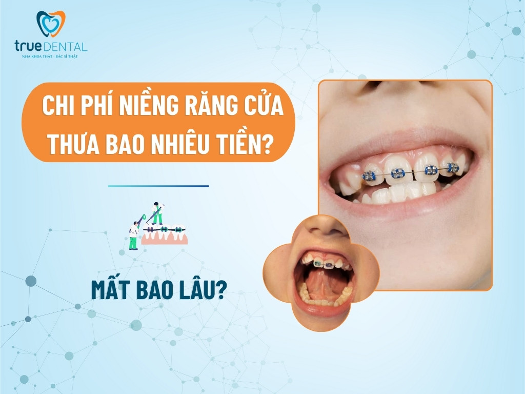Chi phí niềng răng cửa thưa bao nhiêu tiền? Mất bao lâu? 13 Chi phí niềng răng cửa thưa bao nhiêu tiền? Mất bao lâu?