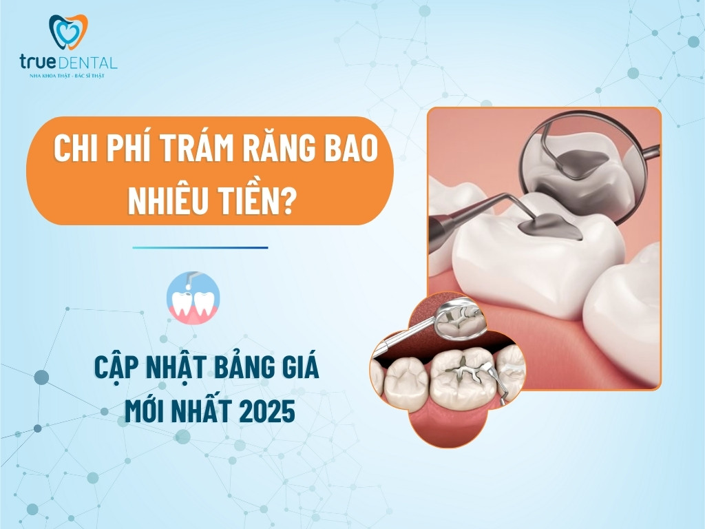 Chi phí trám răng bao nhiêu tiền? Cập nhật bảng giá mới nhất 2025 11 Chi phí trám răng bao nhiêu tiền? Cập nhật bảng giá mới nhất 2025