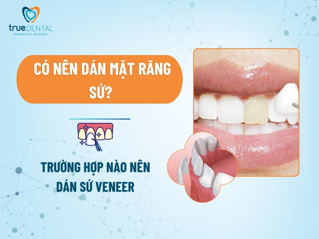 Có nên dán mặt răng sứ? Trường hợp nào nên dán sứ Veneer