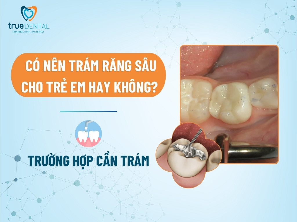 Có nên trám răng sâu cho trẻ em hay không? Trường hợp cần trám