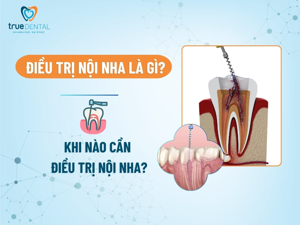 Điều trị nội nha là gì? Khi nào cần điều trị nội nha?
