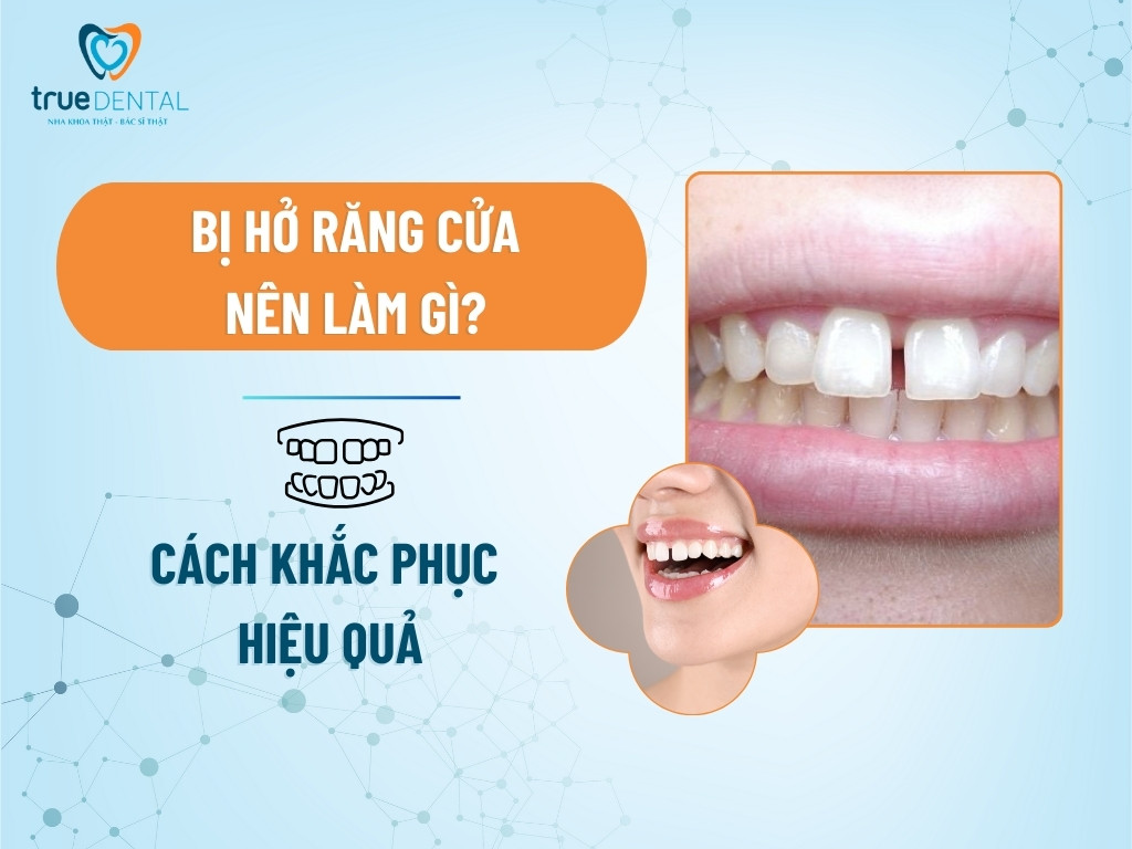 Bị hở răng cửa nên làm gì? Cách khắc phục hiệu quả