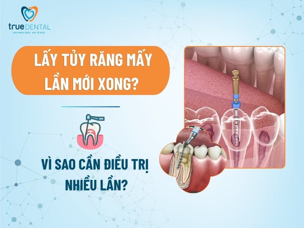 Lấy tủy răng mấy lần mới xong? Vì sao cần điều trị nhiều lần?