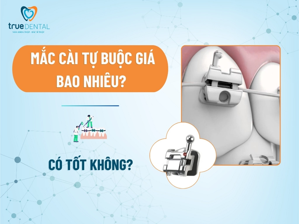 Mắc cài tự buộc giá bao nhiêu? Có tốt không?