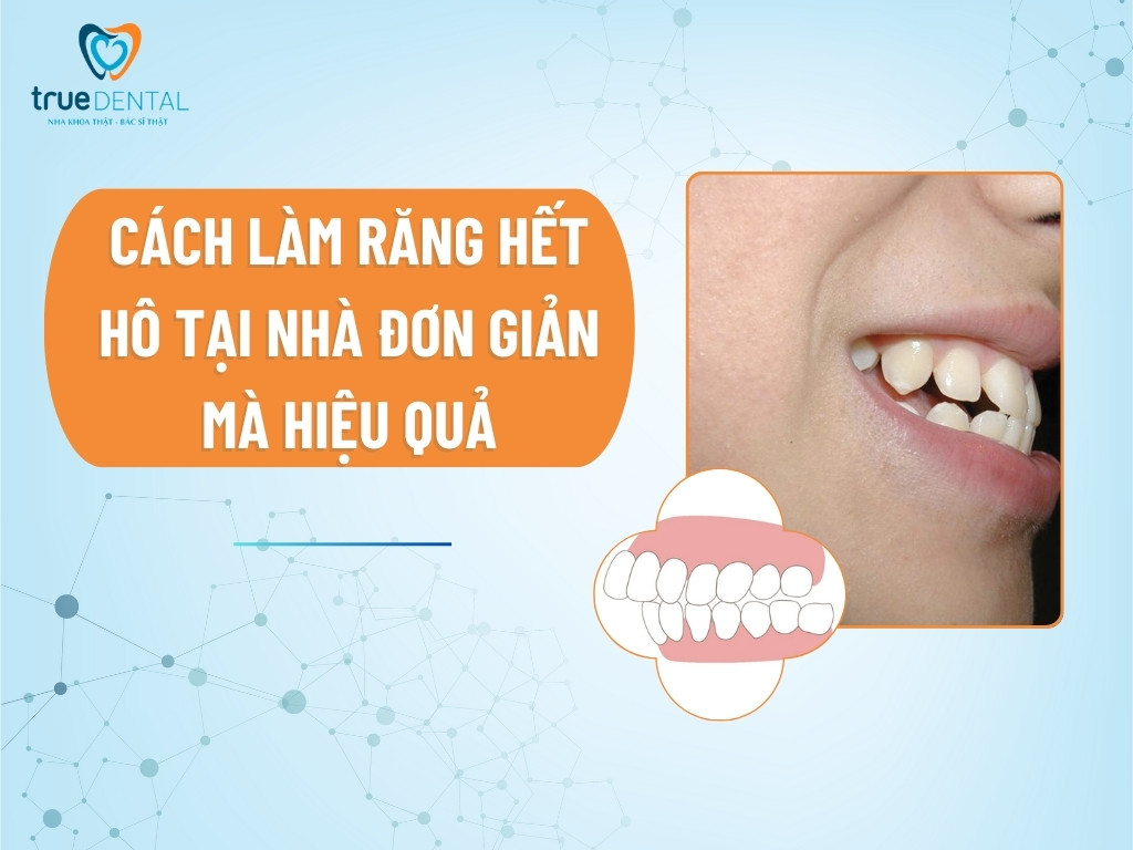 Niềng răng hô tại nhà đơn giản mà hiệu quả - True Dental 10 Cách làm răng hết hô tại nhà đơn giản mà hiệu quả