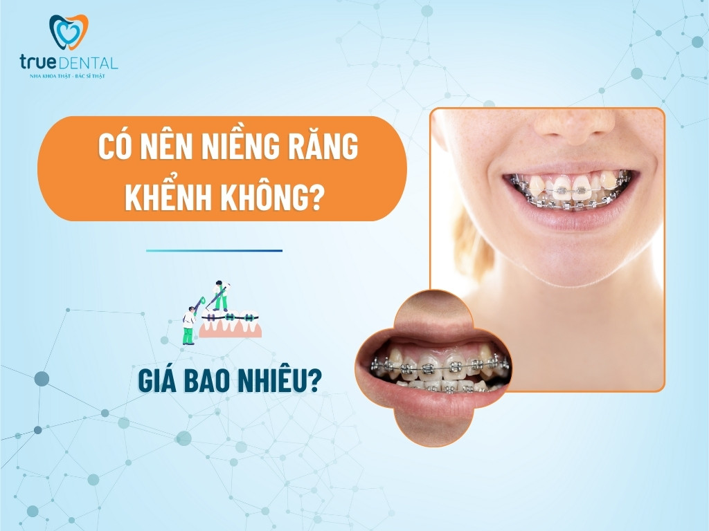 Có nên niềng răng khểnh không? Giá bao nhiêu 9 Có nên niềng răng khểnh không? Giá bao nhiêu