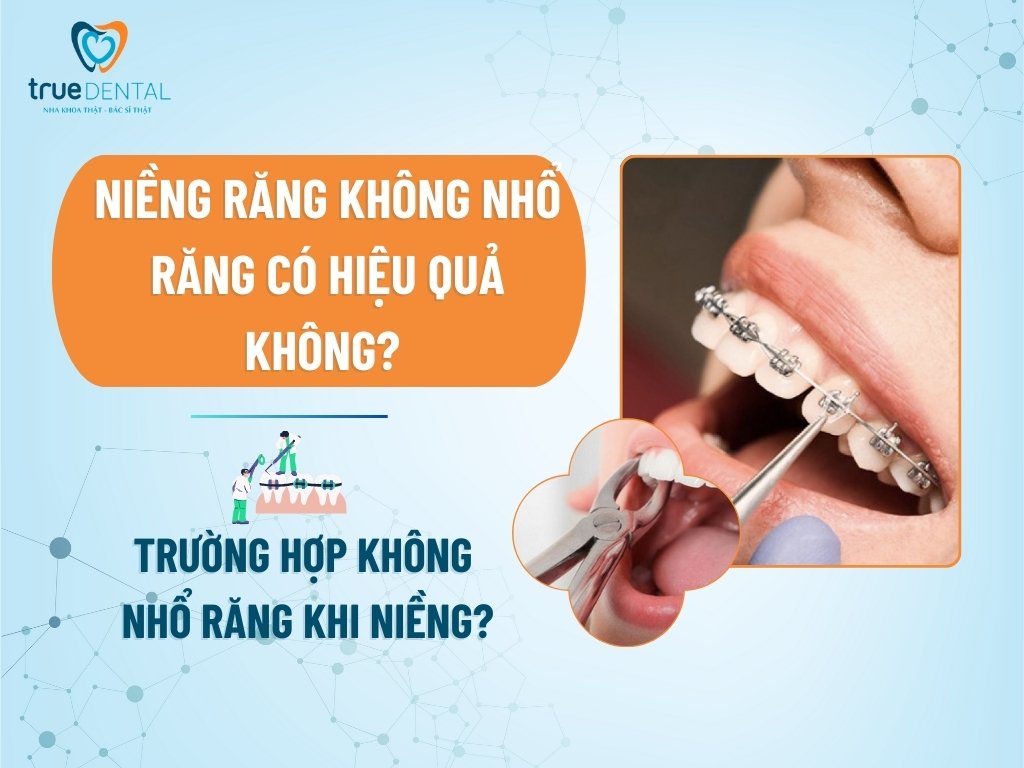 Niềng răng không nhổ răng có hiệu quả không? Trường hợp không nhổ răng khi niềng? 7 Niềng răng không nhổ răng có hiệu quả không? Trường hợp không nhổ răng khi niềng?