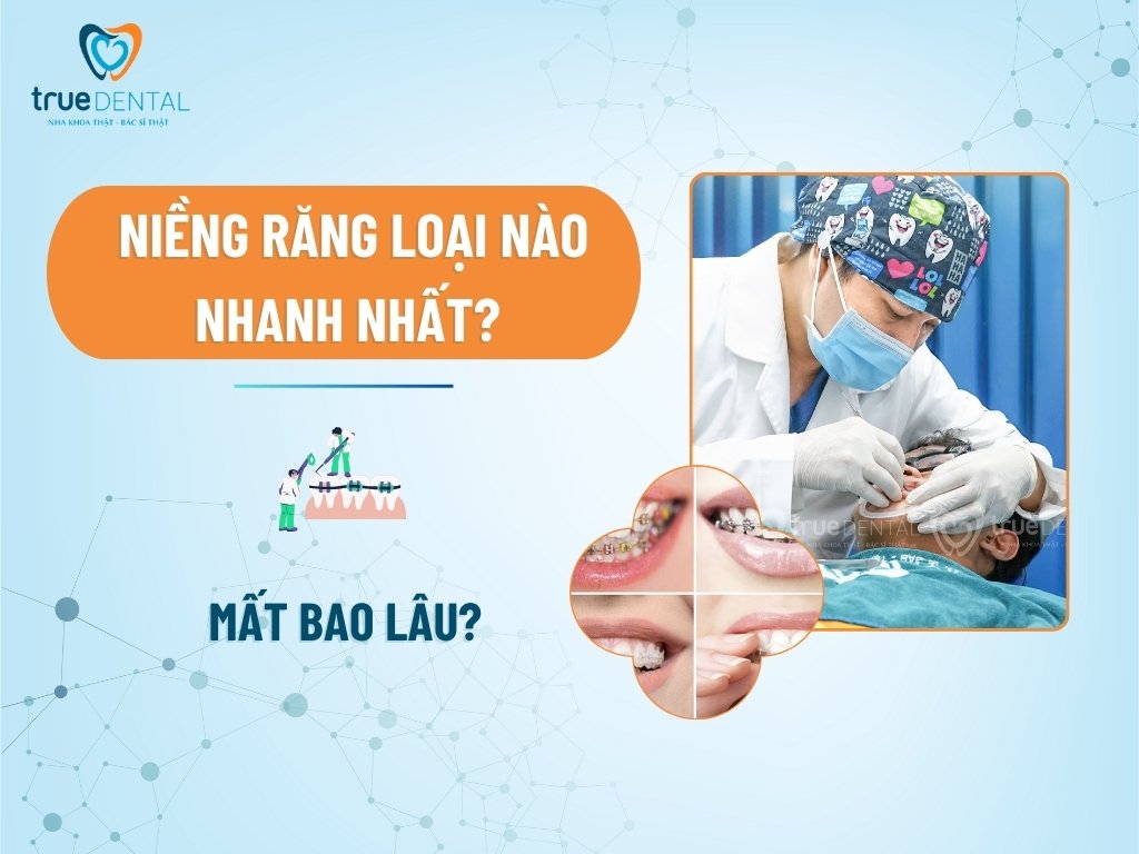Niềng răng loại nào nhanh nhất? Mất bao lâu? 6 Niềng răng loại nào nhanh nhất? Mất bao lâu?