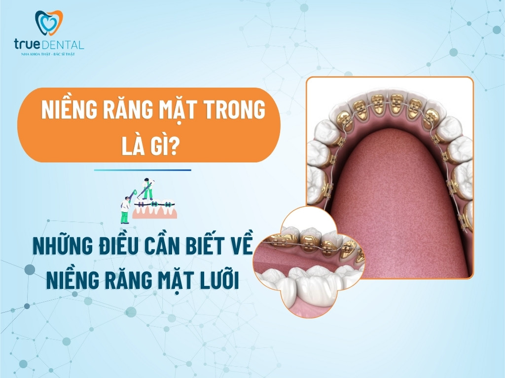 Niềng răng mặt trong là gì? Những điều cần biết về niềng răng mặt lưỡi 10 Niềng răng mặt trong là gì? Những điều cần biết về niềng răng mặt lưỡi