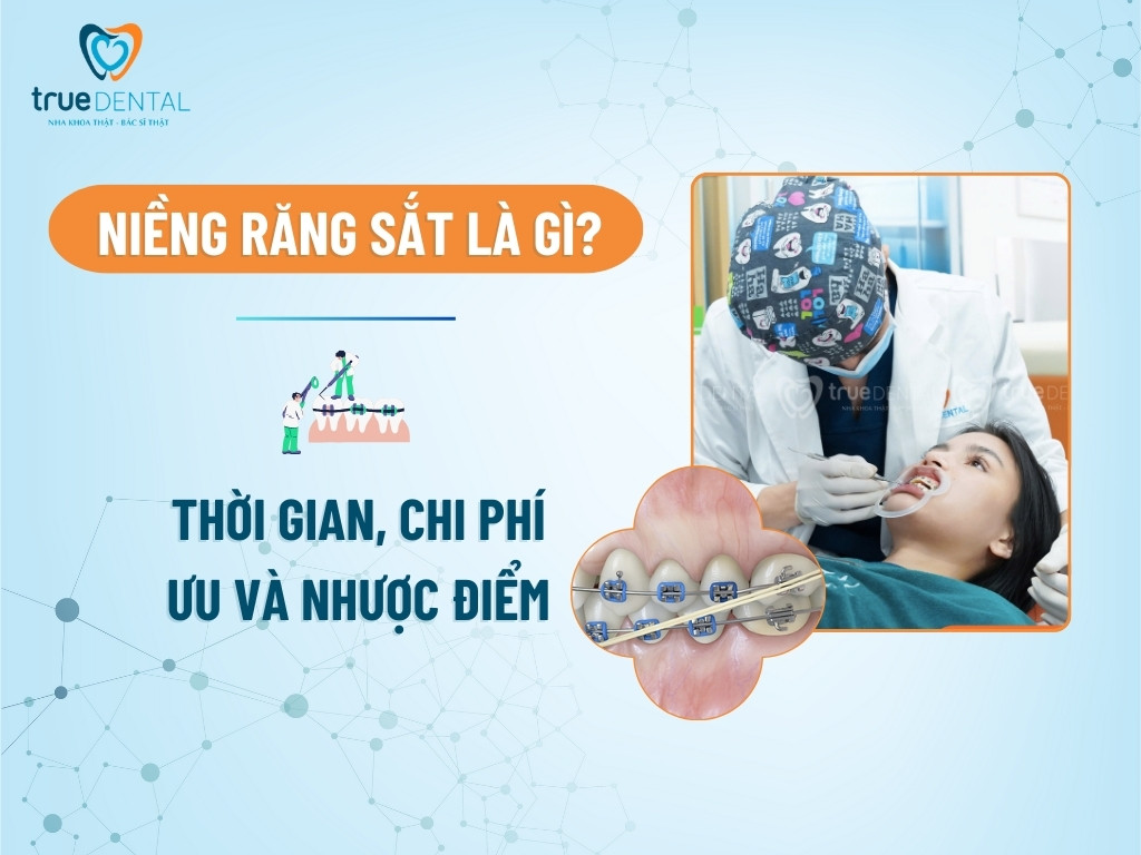Niềng răng sắt là gì? Thời gian, chi phí, ưu và nhược điểm 12 Niềng răng sắt là gì? Thời gian, chi phí, ưu và nhược điểm