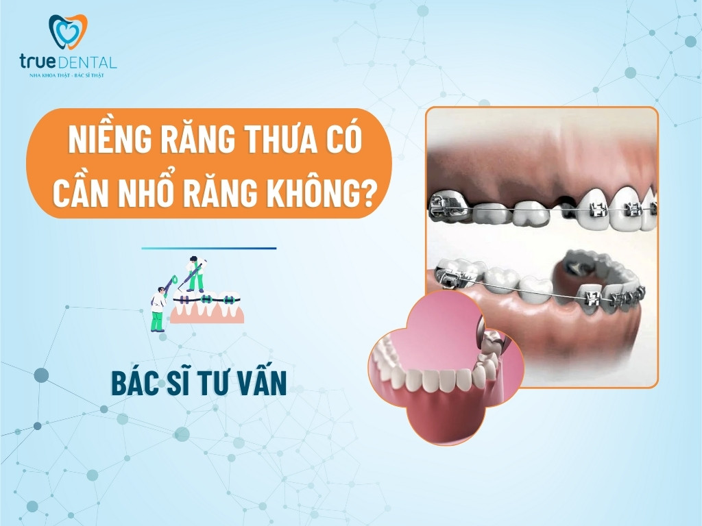 Niềng răng thưa có cần nhổ răng không?- Bác sĩ tư vấn 5 Niềng răng thưa có cần nhổ răng không?- Bác sĩ tư vấn