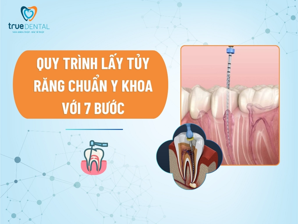 Quy trình lấy tủy răng chuẩn Y khoa với 7 bước